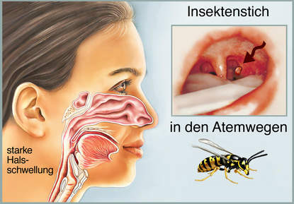 Wespenstich im Mund oder Atemwege